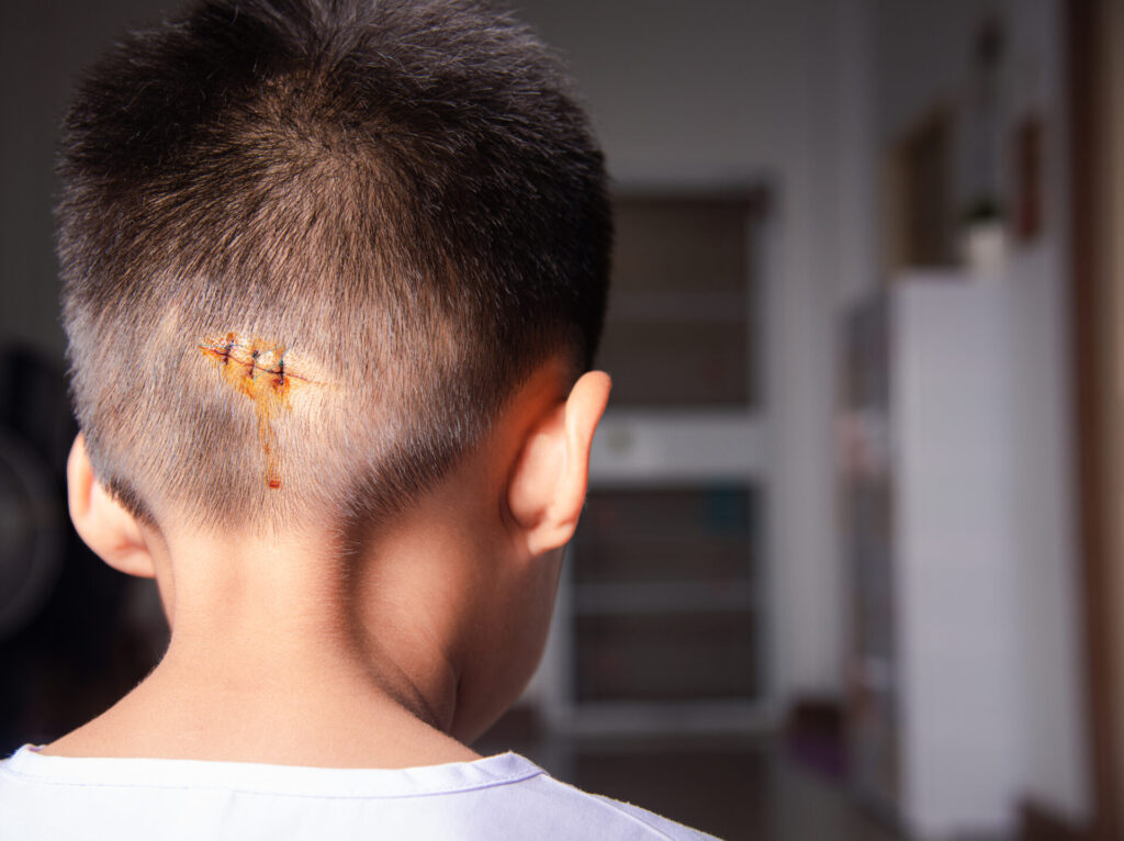 a stitched up wound on the back of a little boy's head