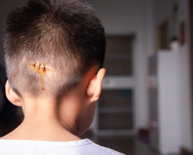 a stitched up wound on the back of a little boy's head