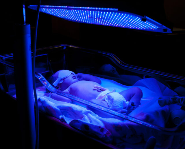 baby under UV light getting treatment for elevated bilirubin levels