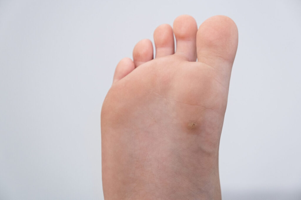wart on a foot
