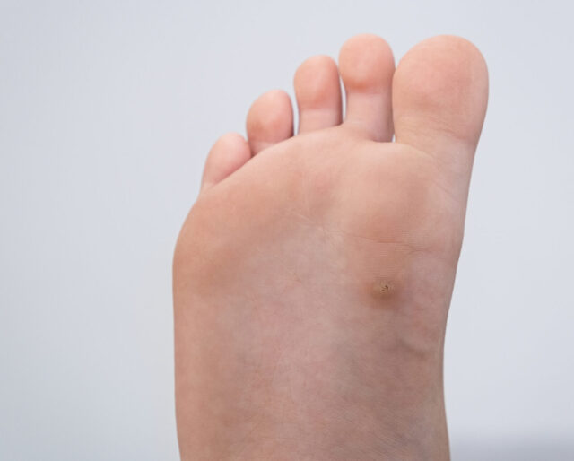 wart on a foot