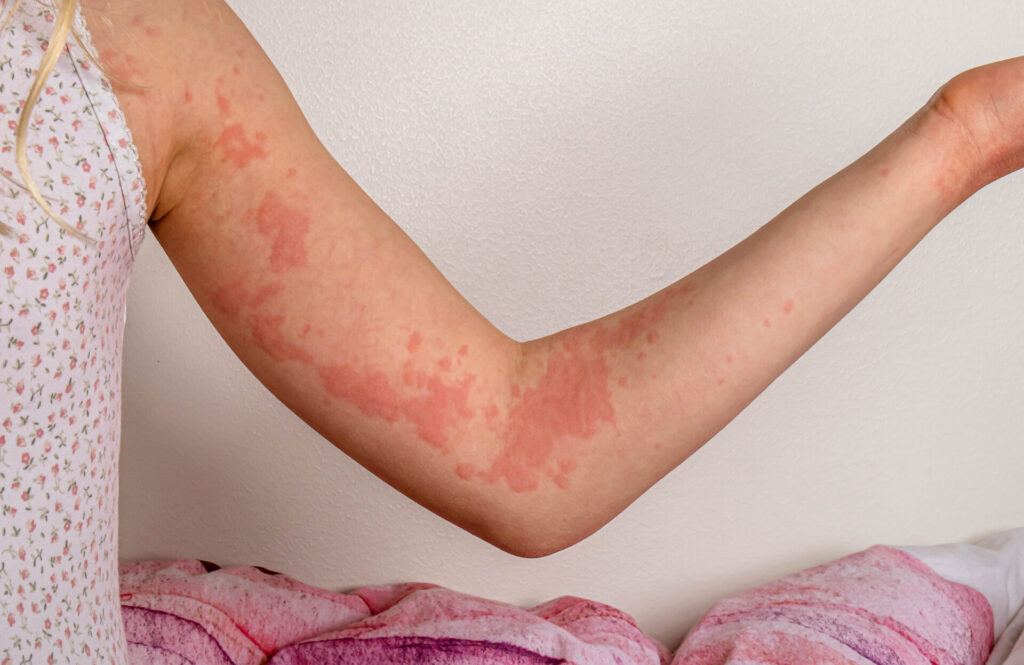 hives on the inside of a girl's arm