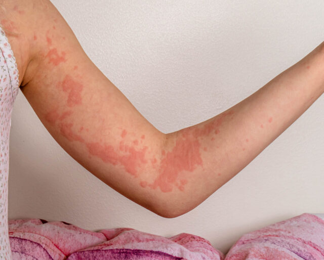 hives on the inside of a girl's arm